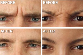 Botox